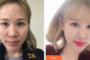 湘西爱尔眼科医院冯菊芝整形价格表附切开双眼皮案例展示