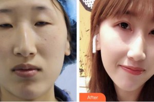 湘西爱尔眼科医院杨秦整形价格表附切开双眼皮案例展示