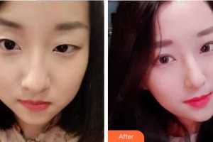 湘西爱尔眼科医院田勇辉整形价格表附切开双眼皮案例展示