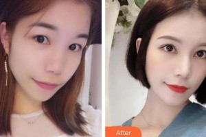 湘西爱尔眼科医院黄慧整形价格表附切开双眼皮案例展示