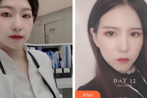 深圳德视佳眼科门诊部姚文琴整形价格表附切开双眼皮案例展示