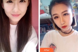 深圳市眼科医院秦磊整形价格表附切开双眼皮案例展示