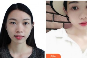 深圳希玛林顺潮眼科医院施礼康整形价格表附切开双眼皮案例展示