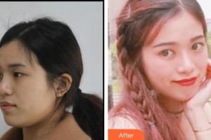 深圳市眼科医院冯其高整形价格表附切开双眼皮案例展示