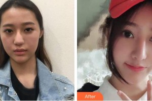 东莞西妃医疗美容医院李娜整形价格表附假体隆鼻案例展示