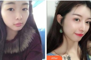 慈溪圣爱医院整形美容科郑聪聪整形价格表附鼻部综合案例展示