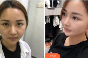 慈溪圣爱医院整形美容科陶卫整形价格表附鼻部综合案例展示