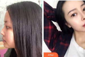 慈溪悦尔医学美容医院展望整形价格表附鼻部综合案例展示