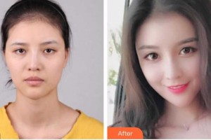 慈溪悦尔医学美容医院张庸柱整形价格表附鼻部综合案例展示