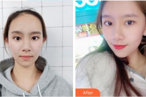 慈溪悦尔医学美容医院陈家鸣整形价格表附肋软骨隆鼻案例展示