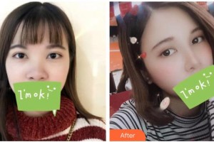 慈溪悦尔医学美容医院赵天宇整形价格表附鼻部综合案例展示