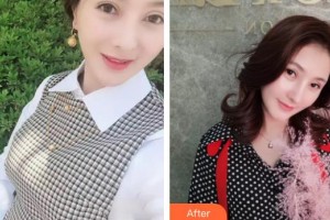 慈溪阳明医疗美容门诊部黄雪丽整形价格表附鼻部综合案例展示