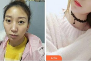 慈溪悦尔医学美容医院林振东整形价格表附鼻部综合案例展示