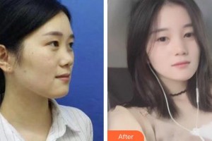 慈溪圣爱医院整形美容科王志忠整形价格表附鼻部综合案例展示