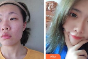 东阳丽莱医疗美容医院姬广翰整形价格表附鼻部综合案例展示