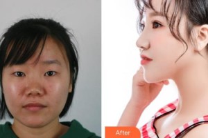 东阳吴少珍医学美容诊所吴少珍整形价格表附耳软骨复合隆鼻案例展示