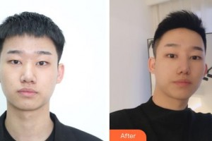 东阳丽莱医疗美容医院邓飞艳整形价格表附鼻部综合案例展示