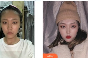 东阳丽莱医疗美容医院颜正安整形价格表附鼻部综合案例展示