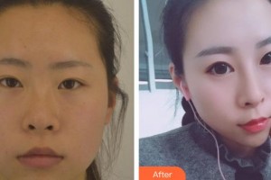 东阳市人民医院整形外科金凯频整形价格表附鼻部综合案例展示