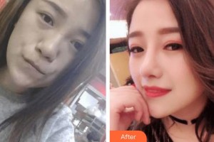 东北国际医院整形美容再生医学中心刘晓燕整形价格表附垫鼻基底案例展示