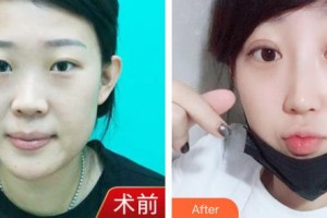 东北国际医院整形美容再生医学中心赵新生整形价格表附鼻部综合例展示
