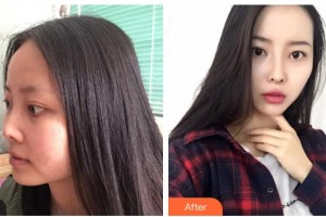 靖江三禾医疗整形美容医院金孝敏整形价格表附鼻部综合案例展示