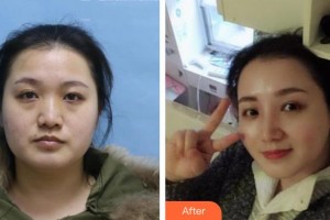 靖江三禾医疗整形美容医院敖家顺整形价格表附鼻部综合案例展示
