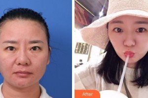 温岭整形美容医院林宝婉整形价格表附埋线提升案例展示