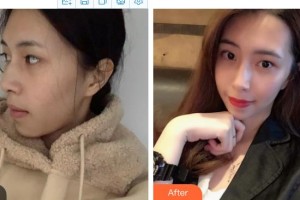 金坛美尔惠医疗美容诊所曹江虹整形价格表附埋线提升案例展示