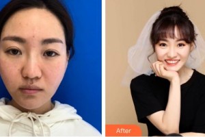 金坛伊曼医疗美容医院夏宏飞整形价格表附埋线提升案例展示