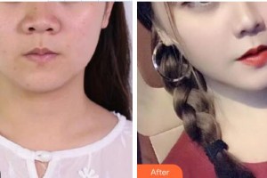 金坛伊曼医疗美容医院晏义兵整形价格表附埋线提升案例展示