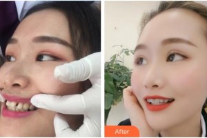 阳春口腔医院黄广柱整形价格表附隐形托槽矫正案例展示