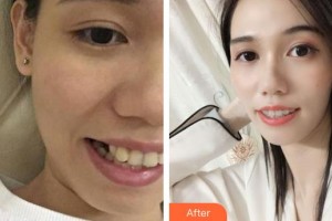 阳春口腔医院陈贤文整形价格表附金属托槽矫正案例展示