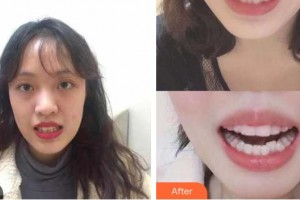 阳春口腔医院卢东晓整形价格表附牙齿隐形矫正例展示