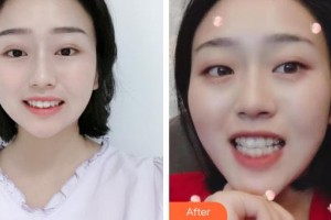 云浮市人民医院烧伤整形手外科钟子敏整形价格表附牙齿隐形矫正案例展示