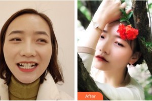 云浮市人民医院烧伤整形手外科吴日强整形价格表附牙齿隐形矫正案例展示