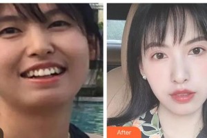 邓州市第三人民医院医学美容整形科范喜明整形价格表附金属托槽矫正案例展示