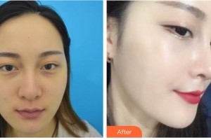 兴义时光整形美容医院刘自成整形价格表附肋软骨隆鼻案例展示