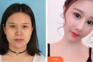 兴义时光整形美容医院刘凯整形价格表附鼻部综合案例展示