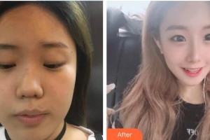 河源曙光医疗美容门诊部王海龙整形价格表附隆鼻案例展示