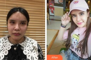 河源曙光医疗美容门诊部崔军整形价格表附鼻部综合案例展示