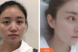 河源曙光医疗美容门诊部石润整形价格表附假体隆鼻案例展示