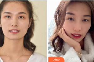 河源拜博东华口腔医院王增全整形价格表附美白贴片案例展示