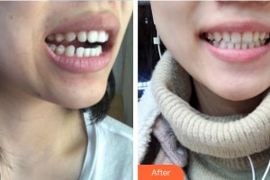 河源曙光医疗美容门诊部许立波整形价格表附牙贴面案例展示