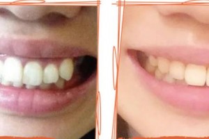 西南医科大学附属口腔医学院附属口腔医院医疗美容科赵威整形价格表附牙齿陶瓷矫正案例展示