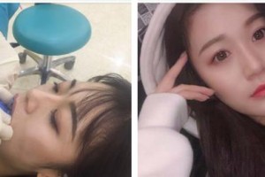 西南医科大学附属口腔医学院附属口腔医院医疗美容科陈俊良整形价格表附牙齿隐形矫正案例展示