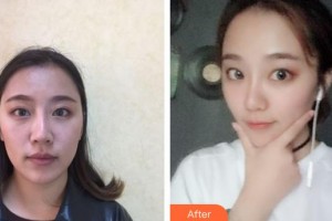 西南医科大学附属中医医院医学美容中心杜宇整形价格表附埋线提升案例展示