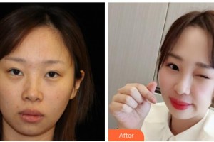 西南医科大学附属医院整形烧伤外科丁晓斌整形价格表附热玛吉案例展示