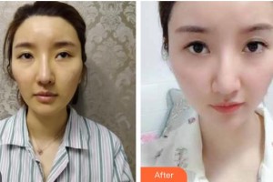 西南医科大学附属医院整形烧伤外科李颖整形价格表附热玛吉案例展示