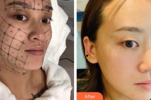 西南医科大学附属医院整形烧伤外科颜洪整形价格表附热玛吉案例展示